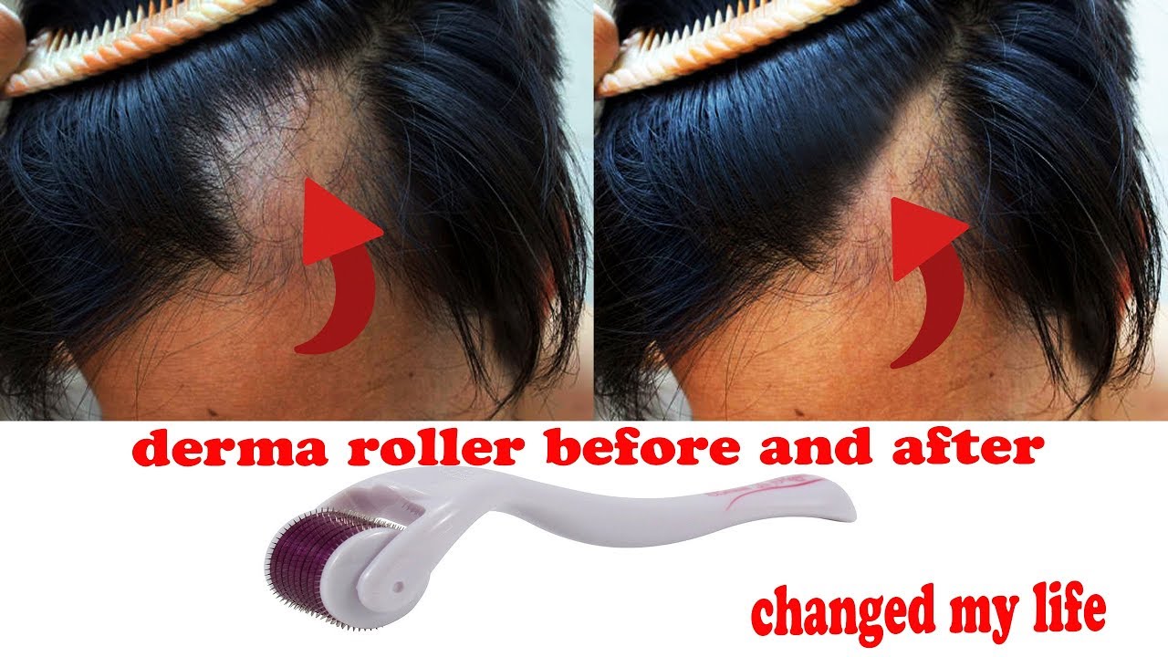 derma roller for hair review